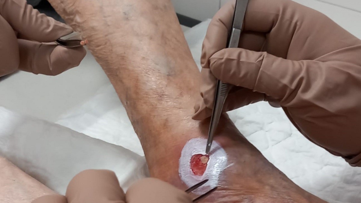 Un CAP de Martorell tracta amb èxit ferides cròniques complexes