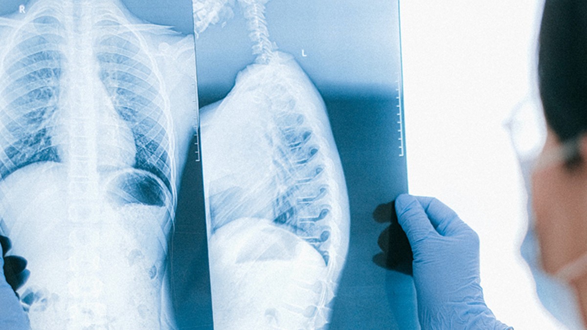 Un nou tractament contra el càncer de pulmó augmenta un 20% la supervivència