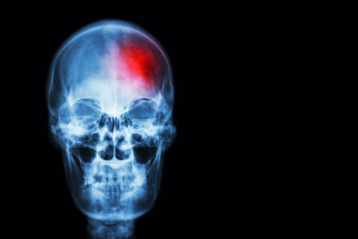 Un TAC realitzat a una persona amb un ictus - Stockdevil