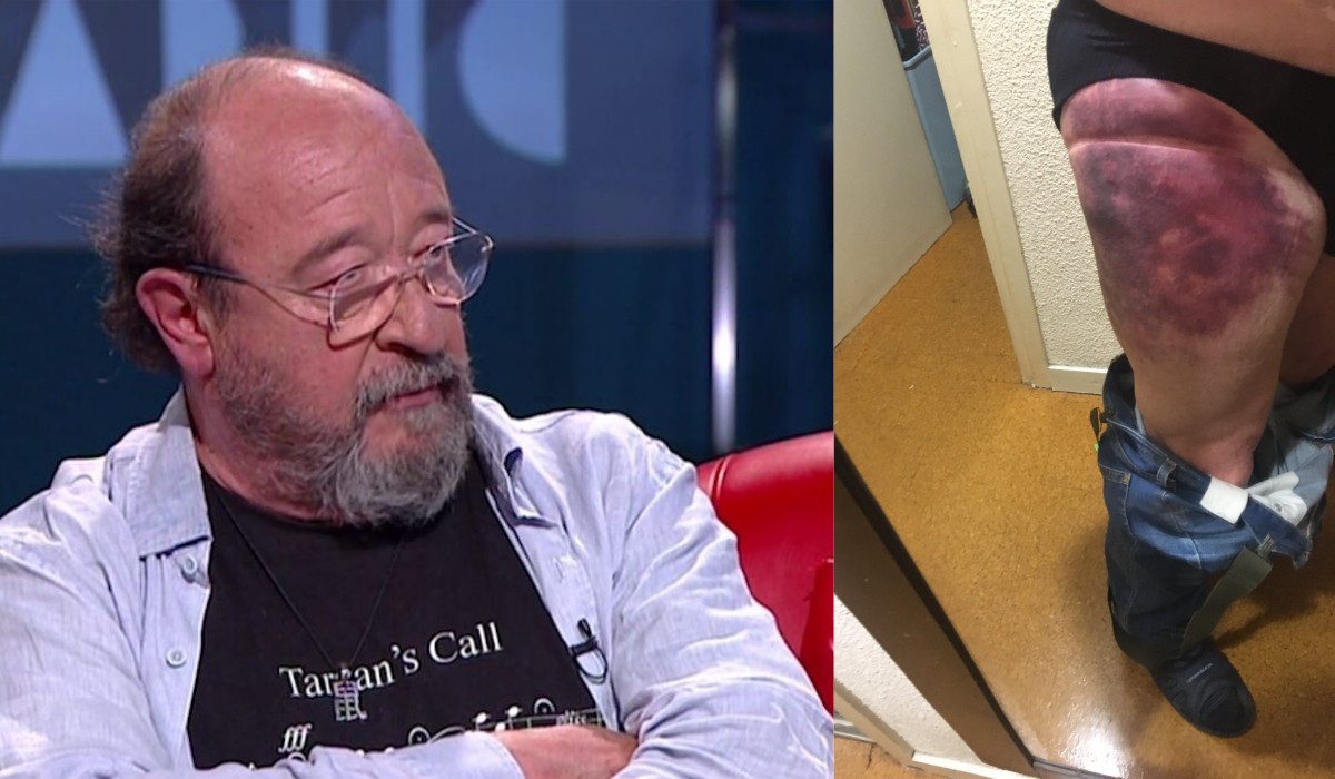Brutal xoc de l'actor Pep Cruz amb un patinet elèctric: «Estic destrossat»