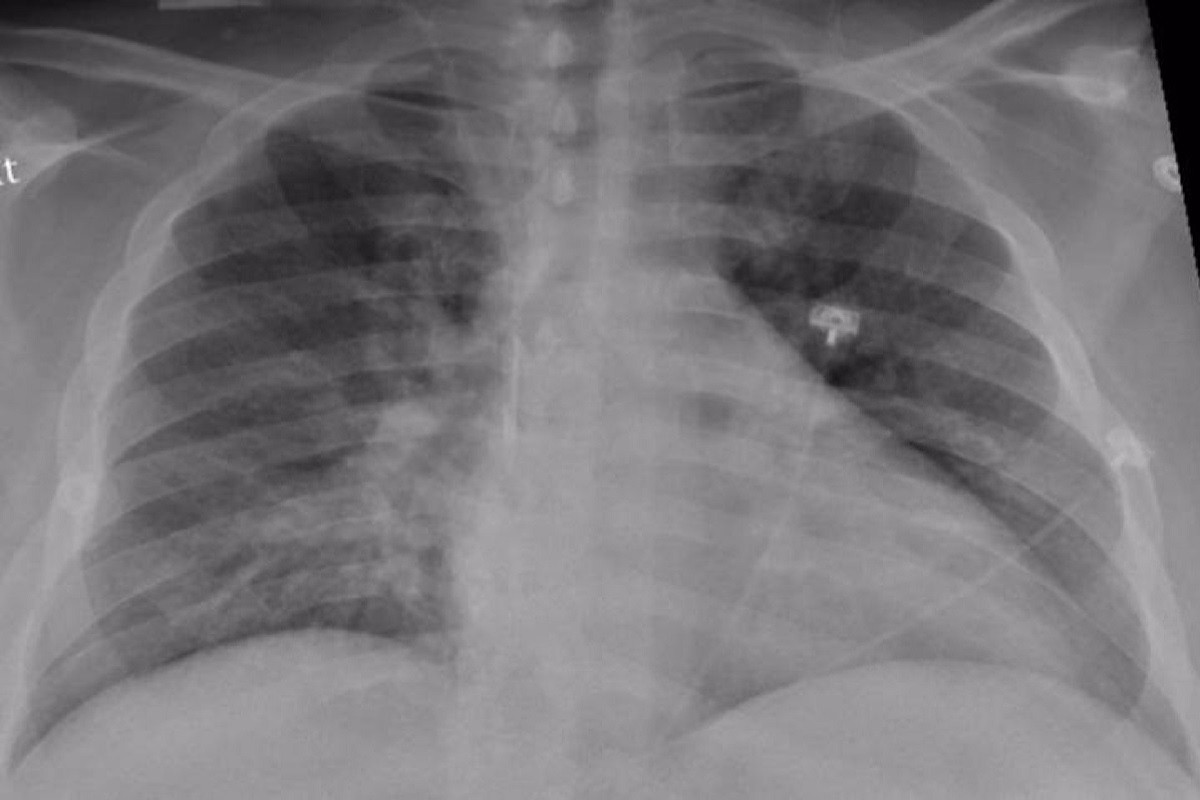 La majoria de pulmons de pacients greus de Covid es recuperen bé, segons un estudi