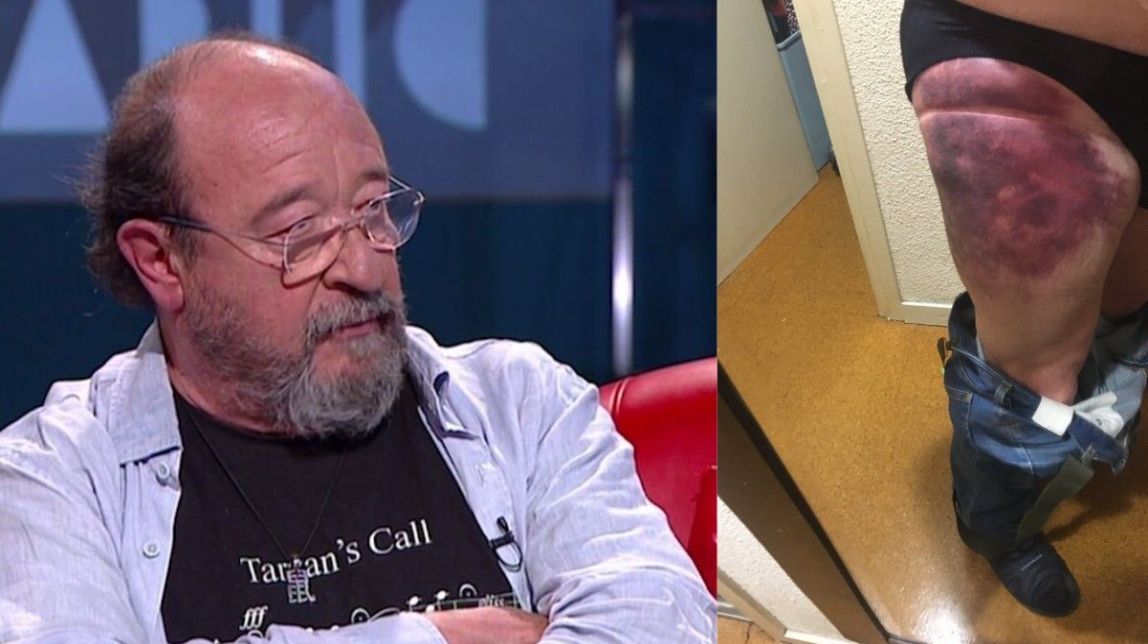 Brutal xoc de l'actor Pep Cruz amb un patinet elèctric: «Estic destrossat»