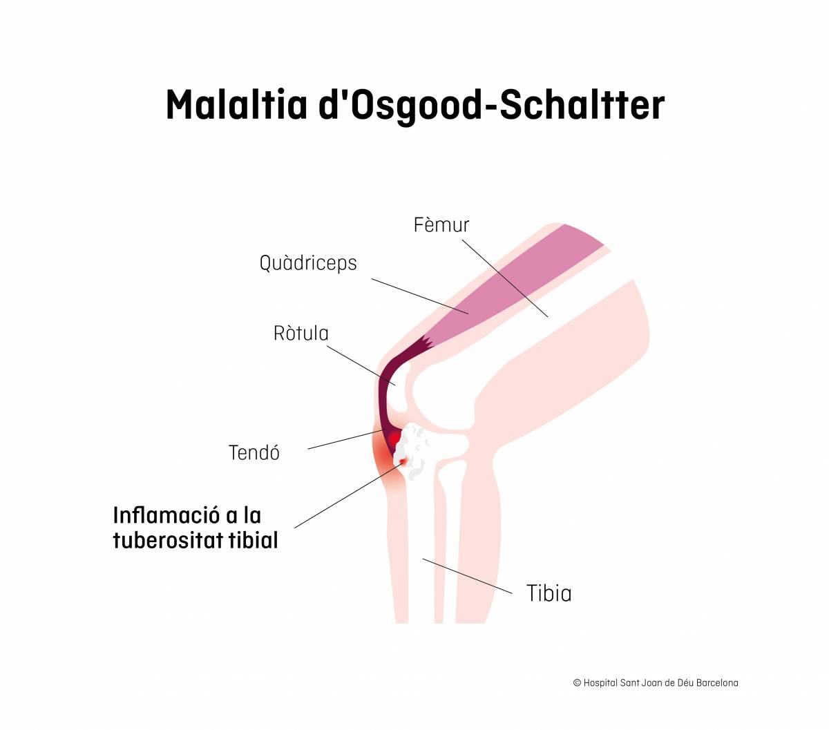 Malaltia d`Osgood-Schlatter - Hospital Sant Joan de Déu Malaltia d`Osgood-Schlatter