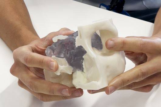 Una de les reconstruccions 3D per valorar l`abordatge de l`operació - Parc Taulí Una de les reconstruccions 3D per valorar l`abordatge de l`operació