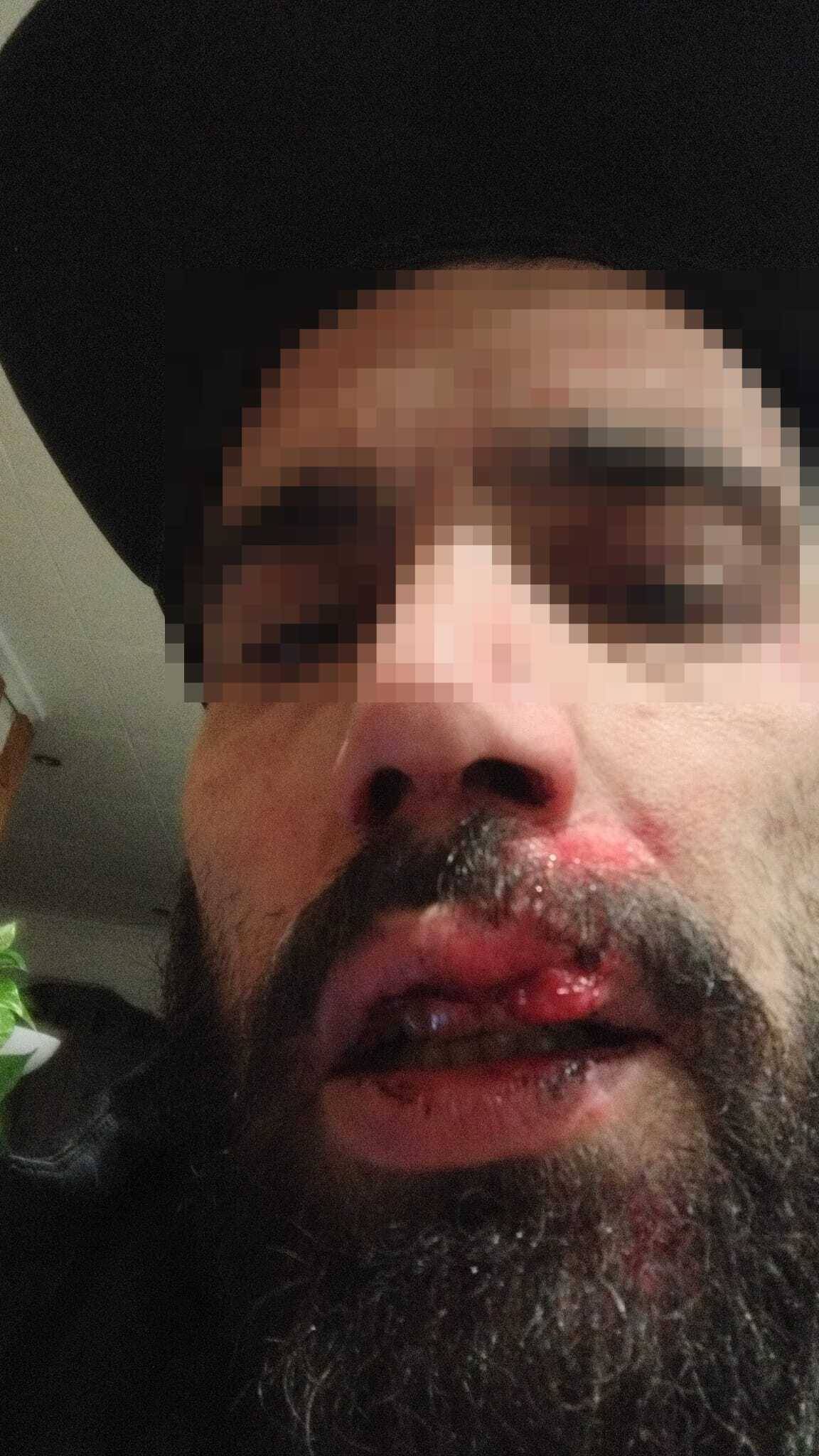 Així va quedar l`aficionat després de la brutal agressió - CEDIDA Així va quedar l`aficionat després de la brutal agressió