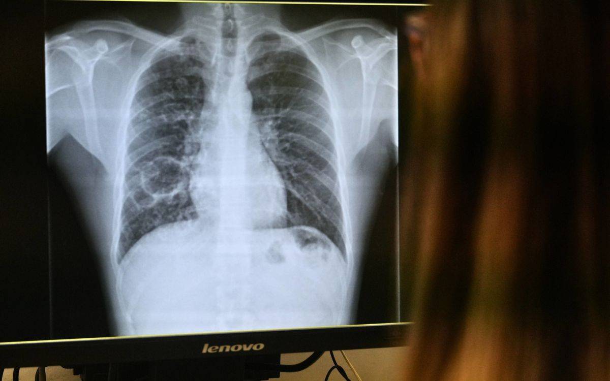 Creixen els casos de tuberculosi a Tarragona: l'Hospital Joan XXIII crea una consulta específica