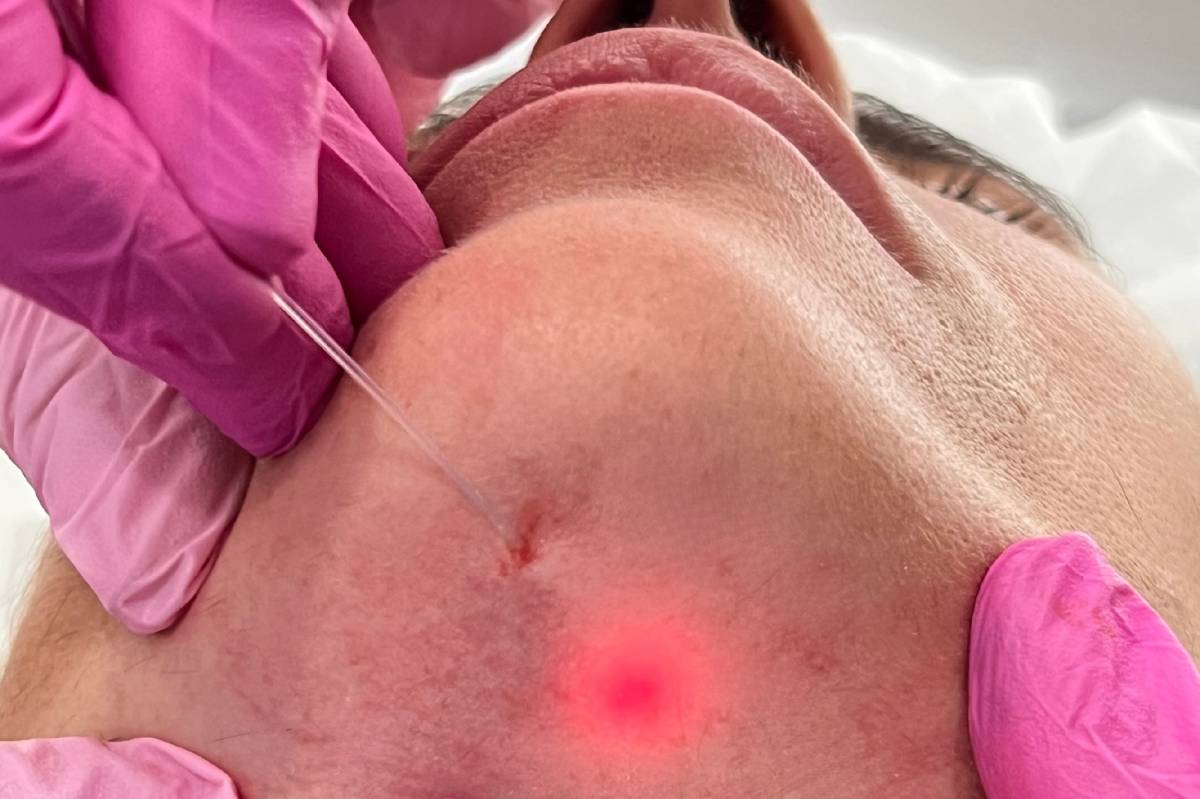 Endolàser: el làser mèdic del qual tothom parla, per la Dra. Nélida Grande