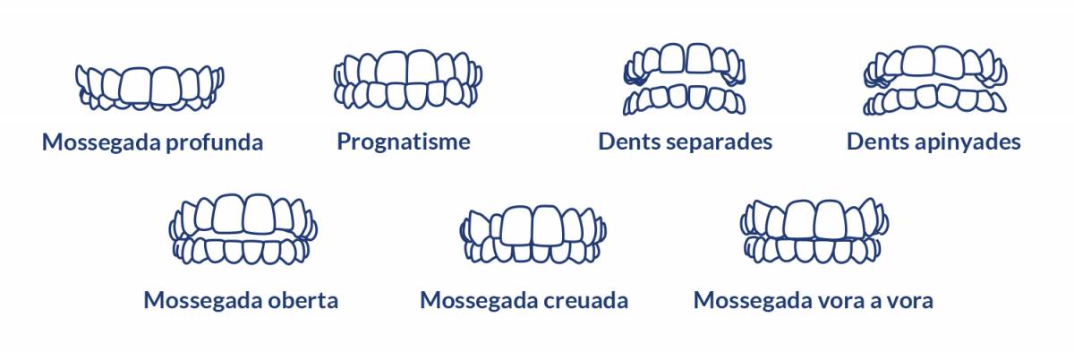 tipus mossegada ortodays policlinic - tipus mossegada ortodays policlinic