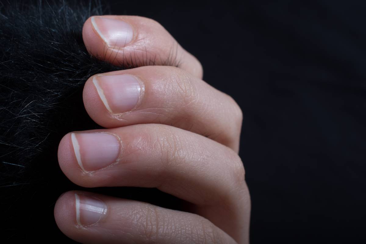 El significat de les ratlles a les ungles: què diu sobre la teva salut, segons una dermatòloga
