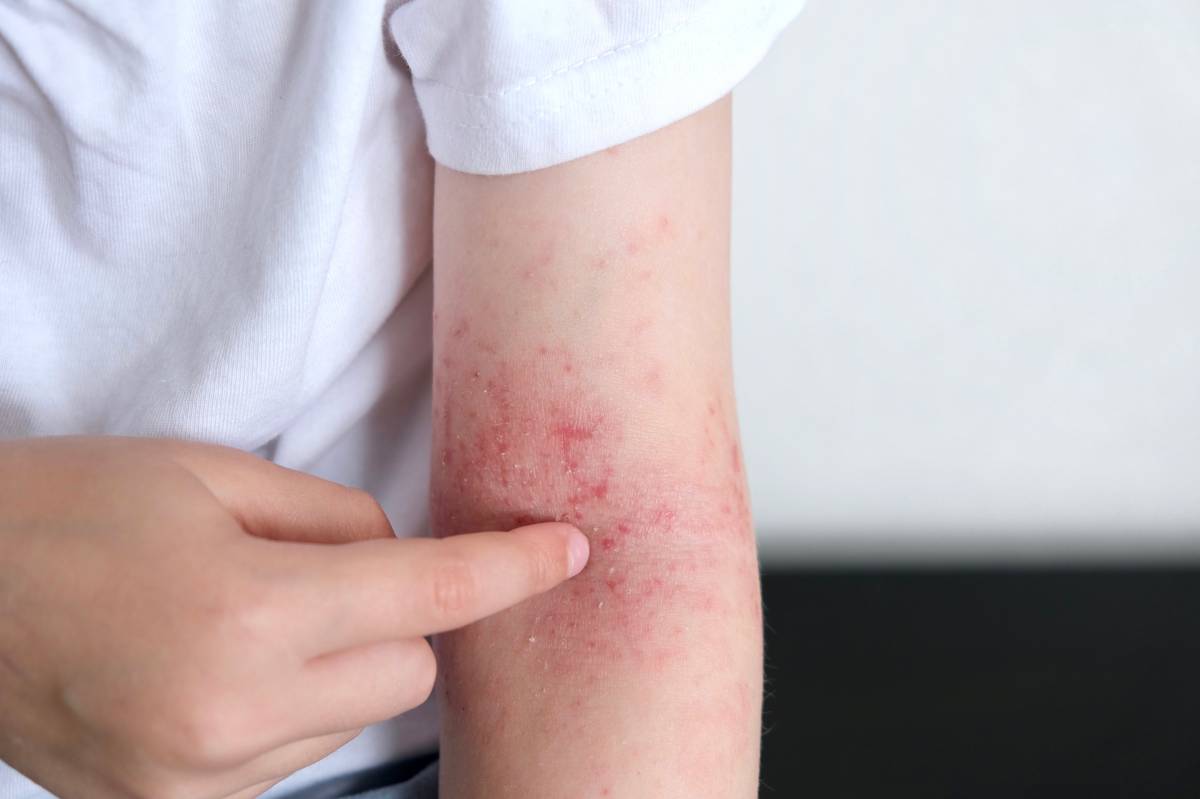 L'avenç científic que podria millorar el tractament de la psoriasi: «Redueix el risc d'efectes secundaris»