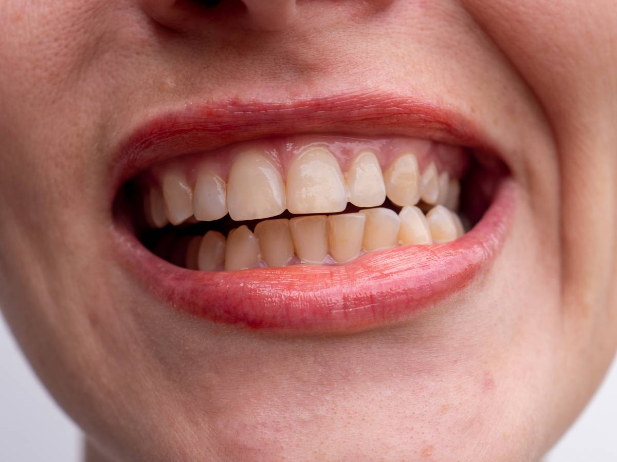 Per què surten taques blanques a les dents? El senyal que no hauries d'ignorar
