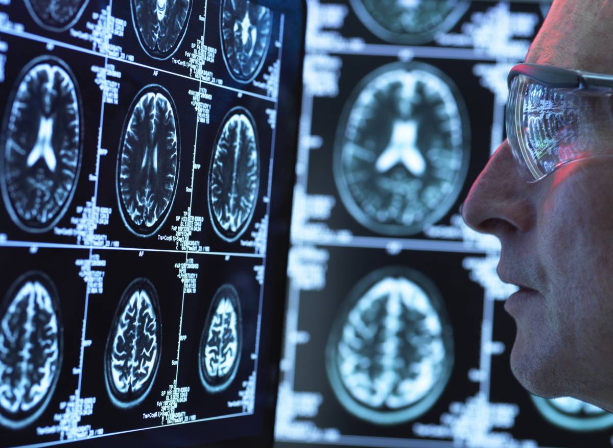 La proteïna del cervell que podria donar pistes sobre el risc d’Alzheimer
