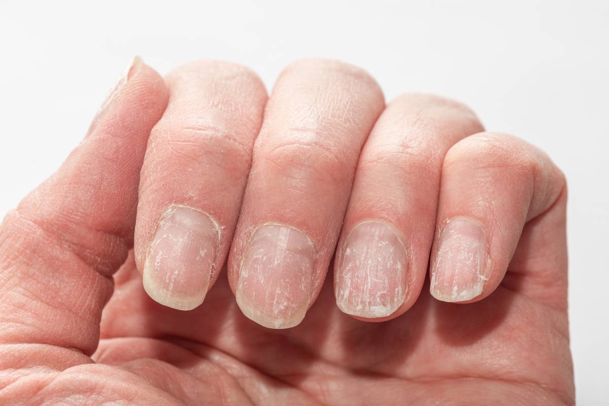 Lorea Bagazgoitia, dermatòloga: «Aquest és el senyal a les ungles que pot indicar manca de proteïnes»